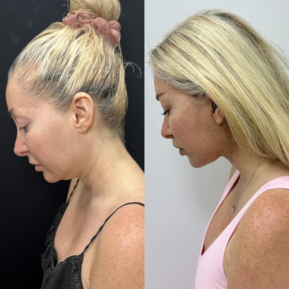 Deep Plane Facelift Before & After Gallery - Patient 406072 - Image 2