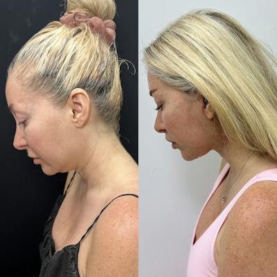 Deep Plane Facelift Before & After Gallery - Patient 406072 - Image 2