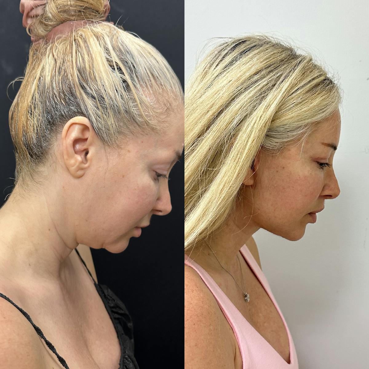 Deep Plane Facelift Before & After Gallery - Patient 406072 - Image 4
