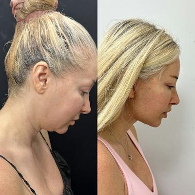 Deep Plane Facelift Before & After Gallery - Patient 406072 - Image 4