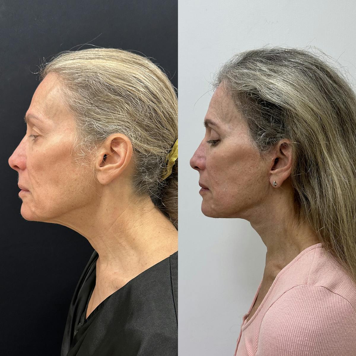 Deep Plane Facelift Before & After Gallery - Patient 113898 - Image 4