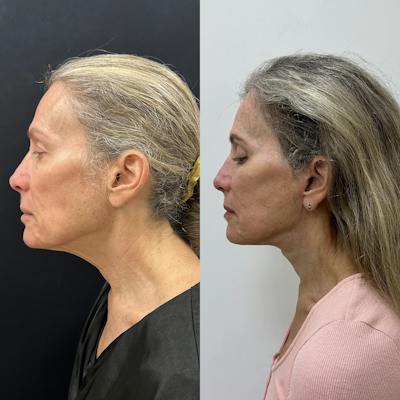 Deep Plane Facelift Before & After Gallery - Patient 113898 - Image 4
