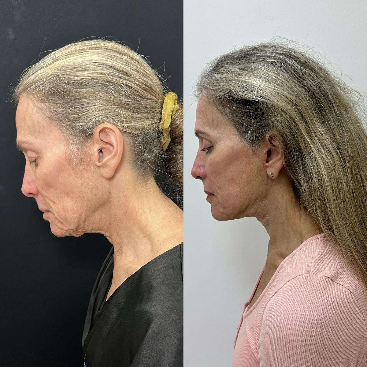 Deep Plane Facelift Before & After Gallery - Patient 113898 - Image 5