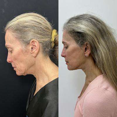 Deep Plane Facelift Before & After Gallery - Patient 113898 - Image 5