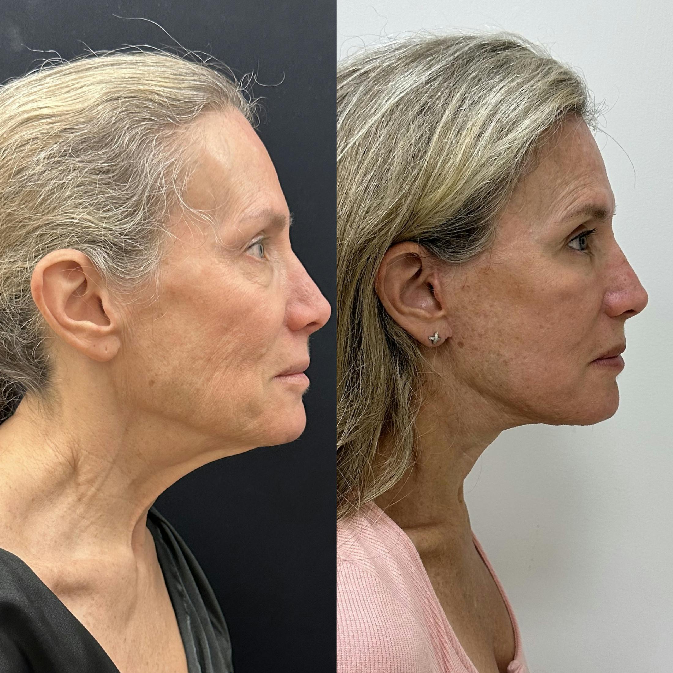 Deep Plane Facelift Before & After Gallery - Patient 113898 - Image 2