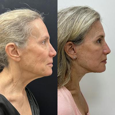Deep Plane Facelift Before & After Gallery - Patient 113898 - Image 2