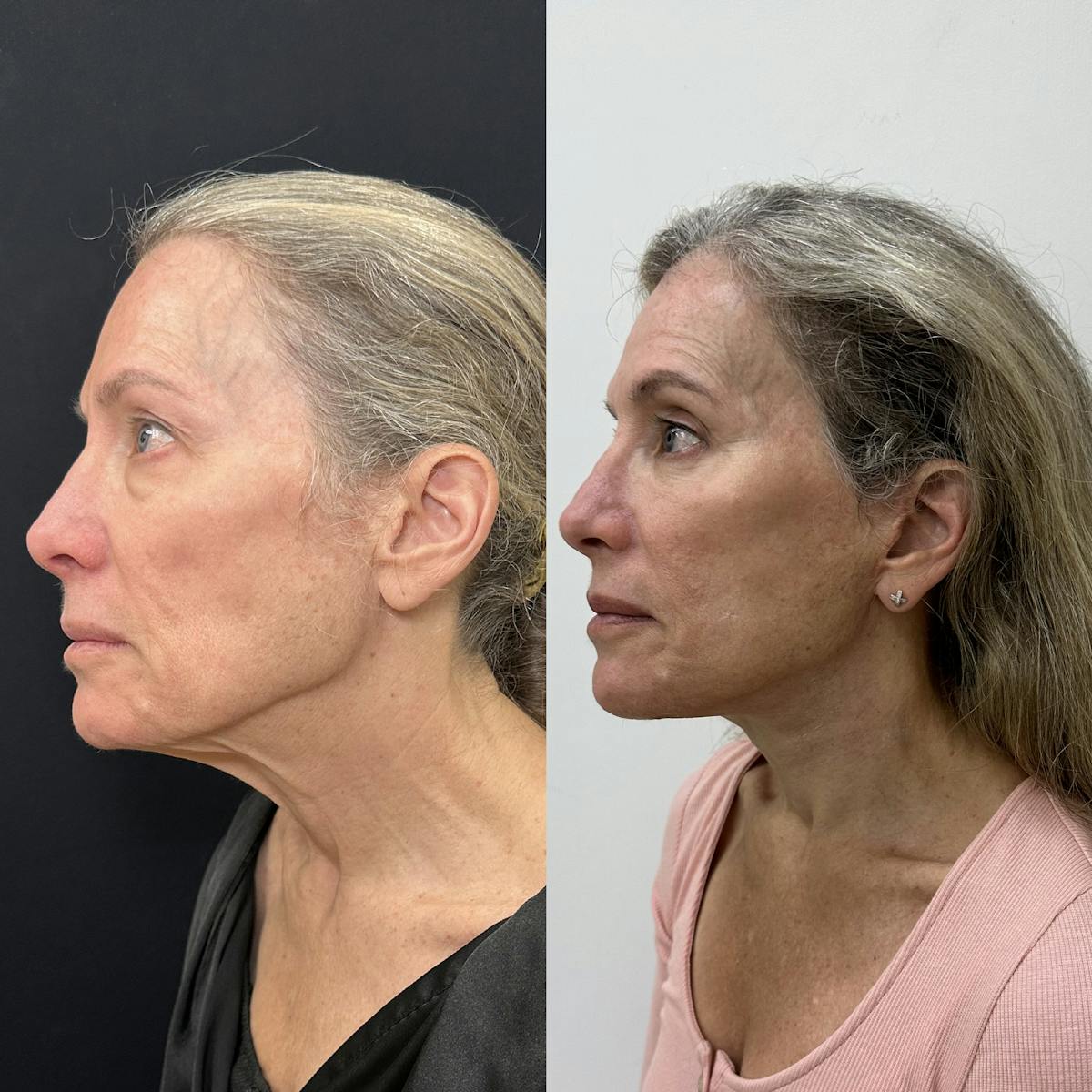 Deep Plane Facelift Before & After Gallery - Patient 113898 - Image 3