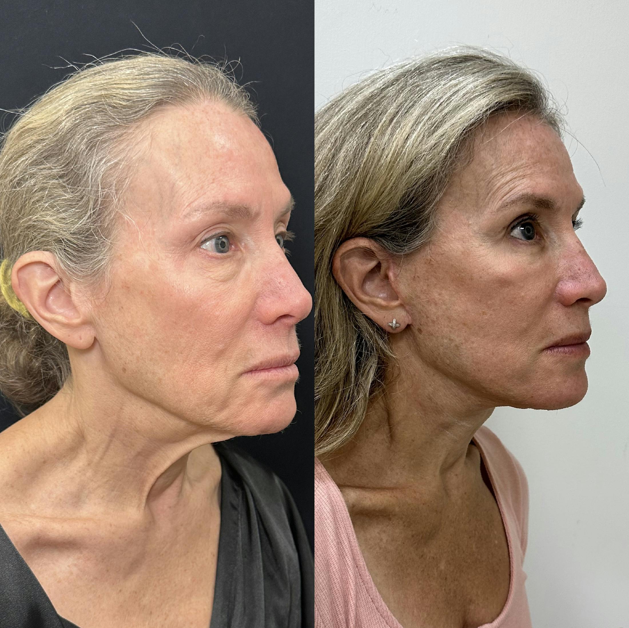 Deep Plane Facelift Before & After Gallery - Patient 113898 - Image 1
