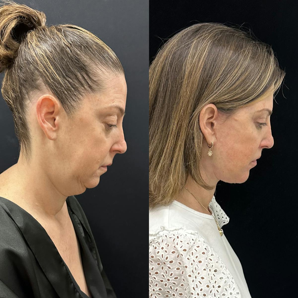Deep Plane Facelift Before & After Gallery - Patient 287077 - Image 3