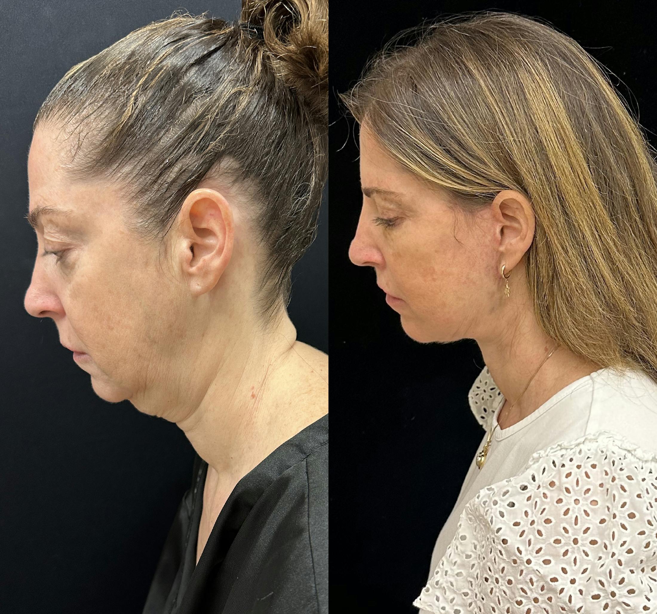Deep Plane Facelift Before & After Gallery - Patient 287077 - Image 6