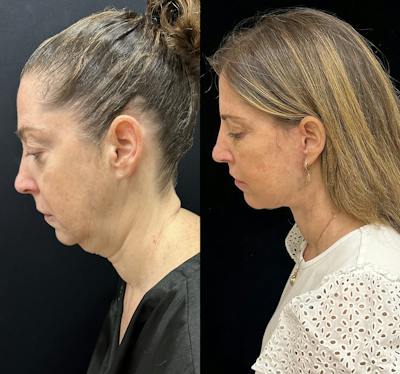 Deep Plane Facelift Before & After Gallery - Patient 287077 - Image 6