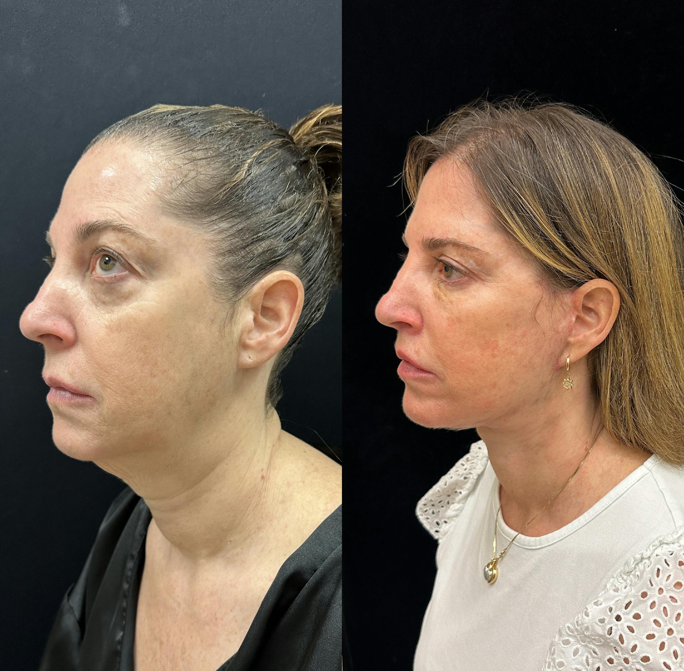 Deep Plane Facelift Before & After Gallery - Patient 287077 - Image 4