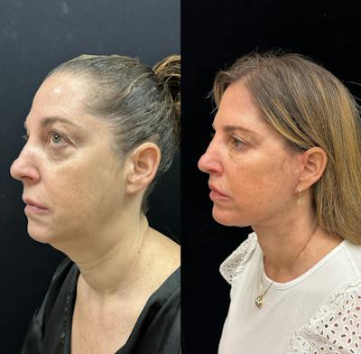 Deep Plane Facelift Before & After Gallery - Patient 287077 - Image 4