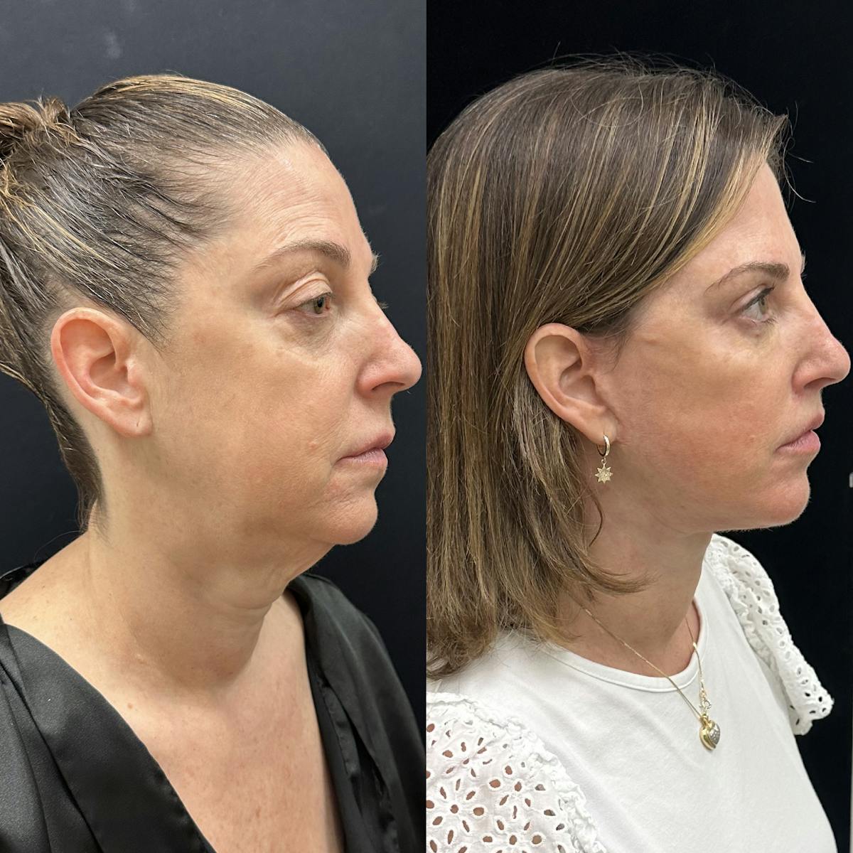 Deep Plane Facelift Before & After Gallery - Patient 287077 - Image 1