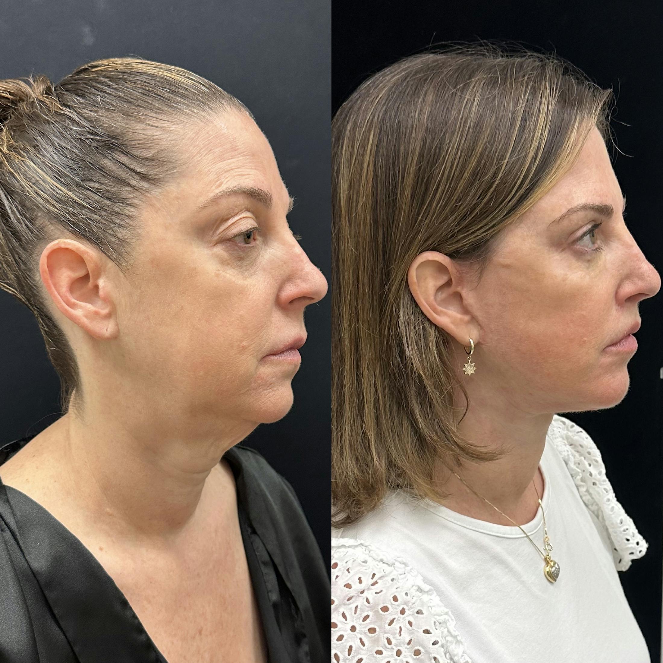 Deep Plane Facelift Before & After Gallery - Patient 287077 - Image 1