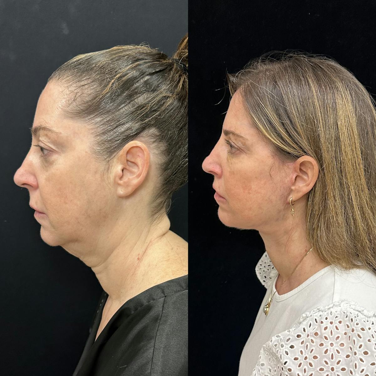 Deep Plane Facelift Before & After Gallery - Patient 287077 - Image 5