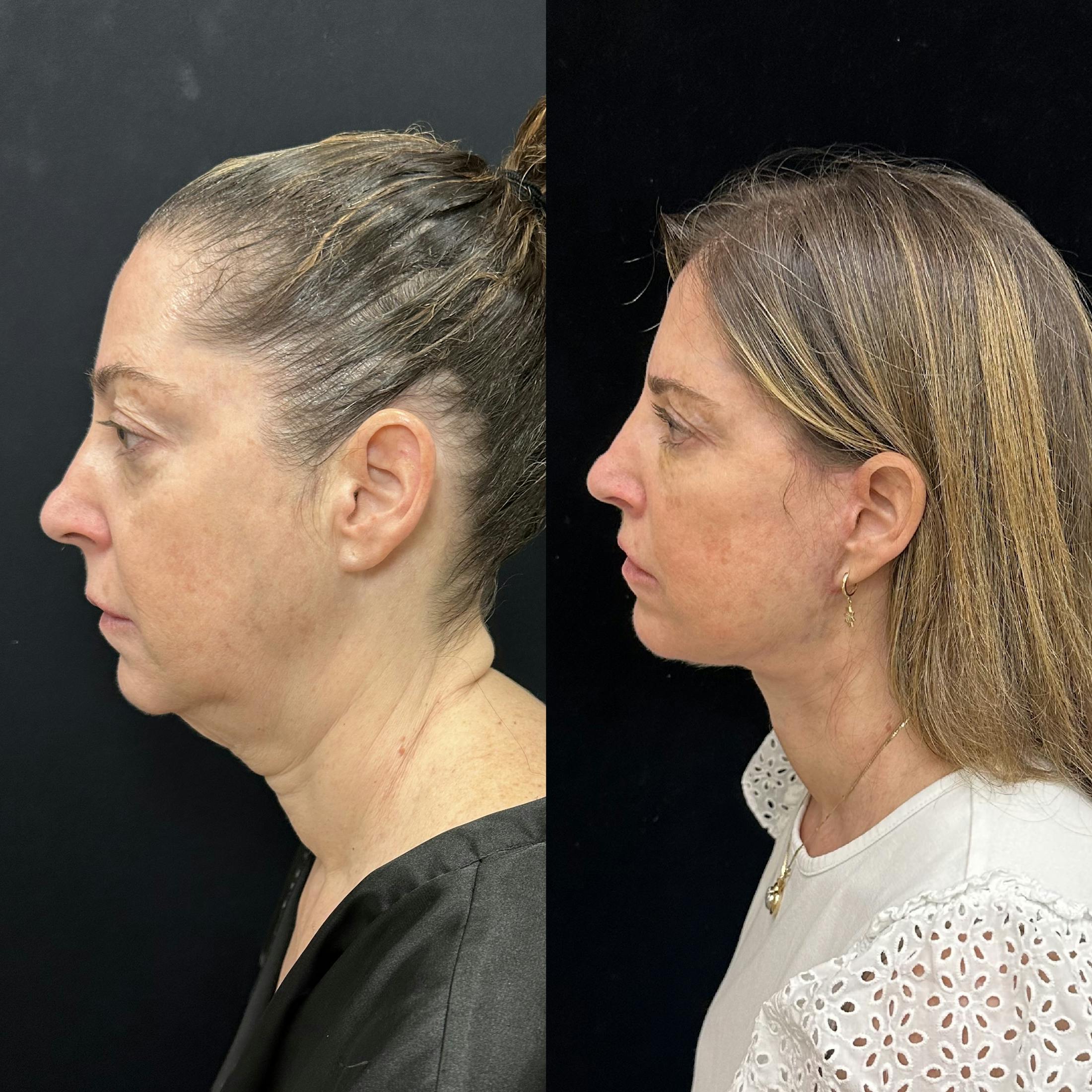 Deep Plane Facelift Before & After Gallery - Patient 287077 - Image 5