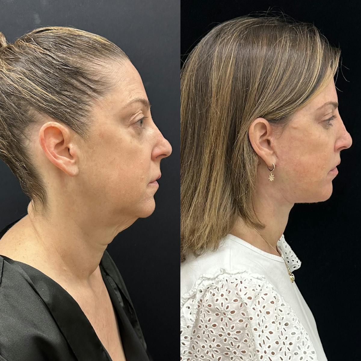 Deep Plane Facelift Before & After Gallery - Patient 287077 - Image 2