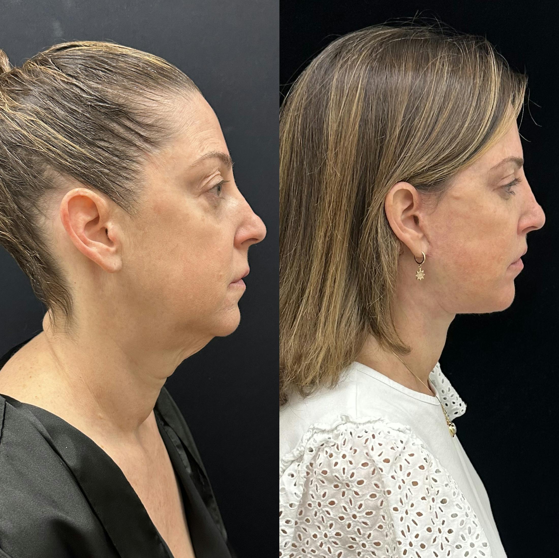 Deep Plane Facelift Before & After Gallery - Patient 287077 - Image 2