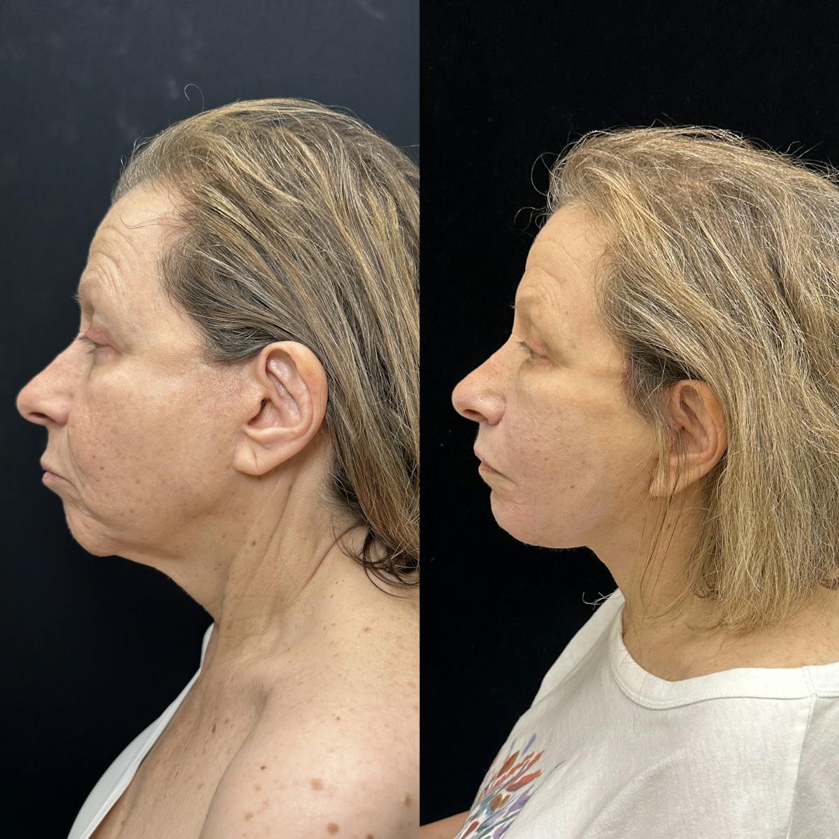 Deep Plane Facelift Before & After Gallery - Patient 155427 - Image 2