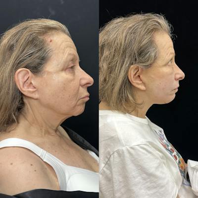 Deep Plane Facelift Before & After Gallery - Patient 155427 - Image 1