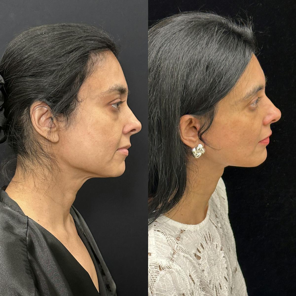 Deep Plane Facelift Before & After Gallery - Patient 847493 - Image 1