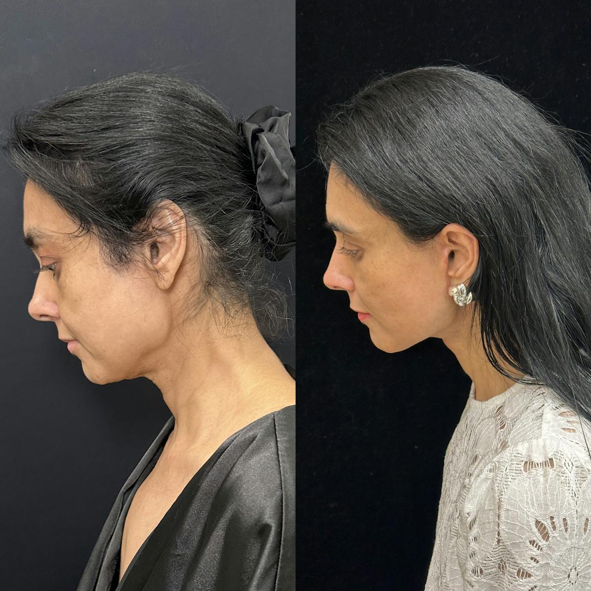 Deep Plane Facelift Before & After Gallery - Patient 847493 - Image 4