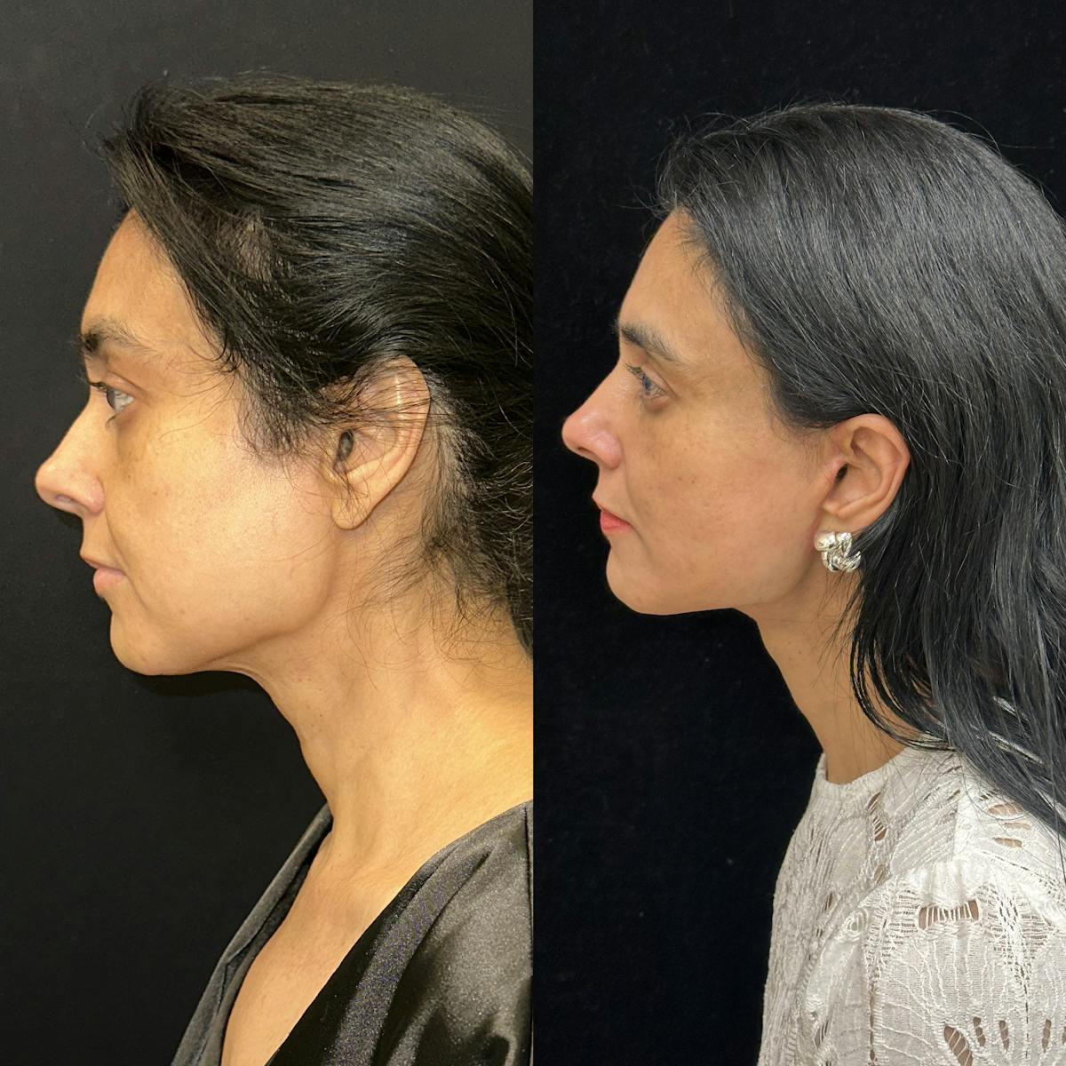 Deep Plane Facelift Before & After Gallery - Patient 847493 - Image 3