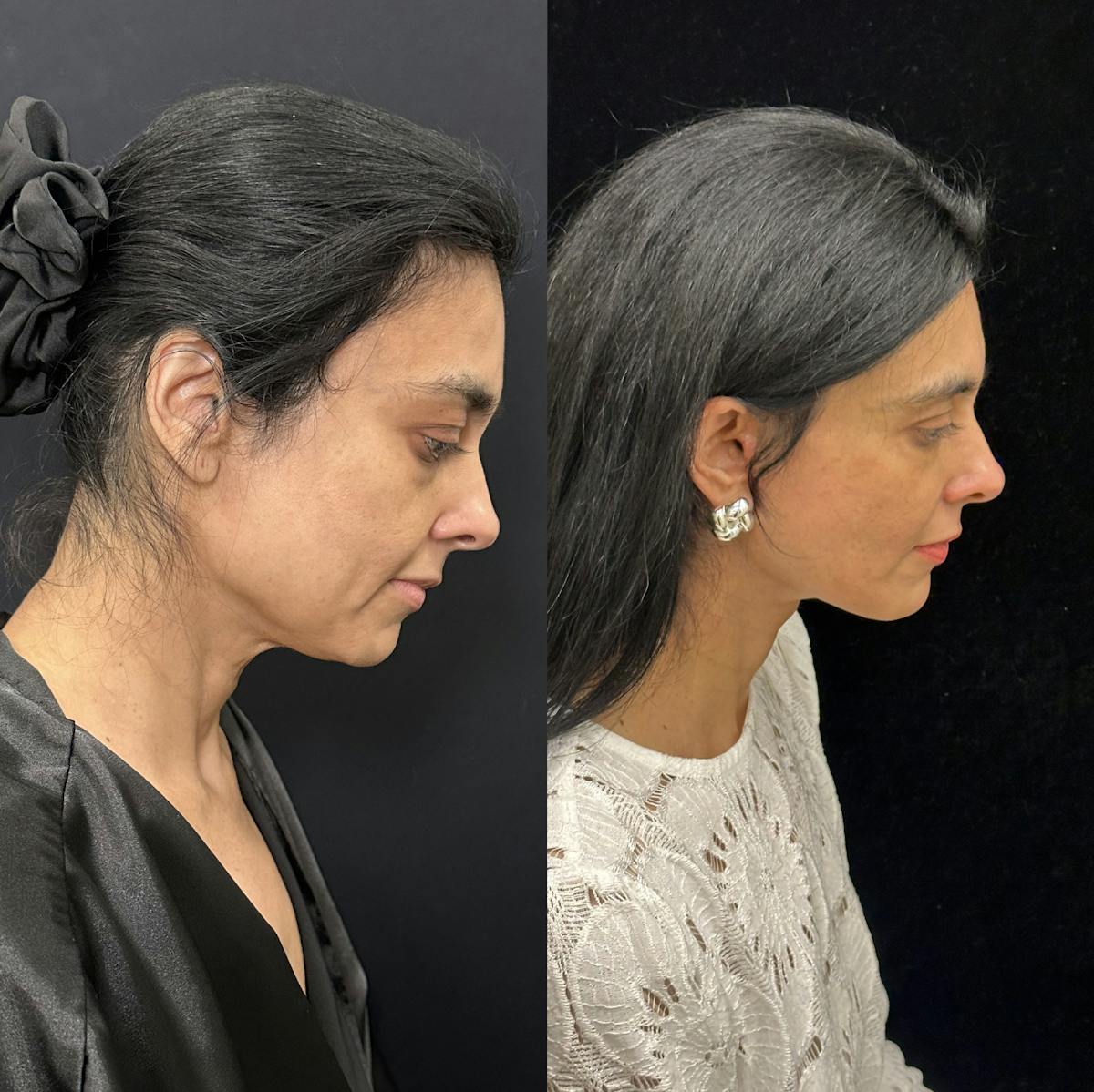 Deep Plane Facelift Before & After Gallery - Patient 847493 - Image 2
