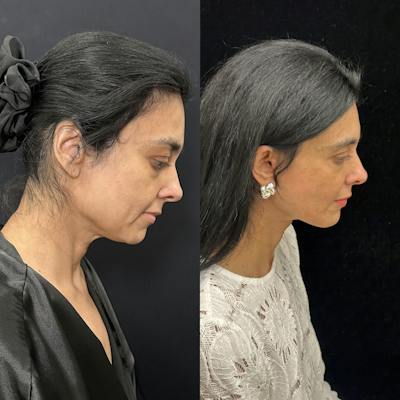 Deep Plane Facelift Before & After Gallery - Patient 847493 - Image 2
