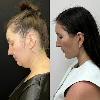 Deep Plane Facelift Before & After Gallery - Patient 332332 - Image 7
