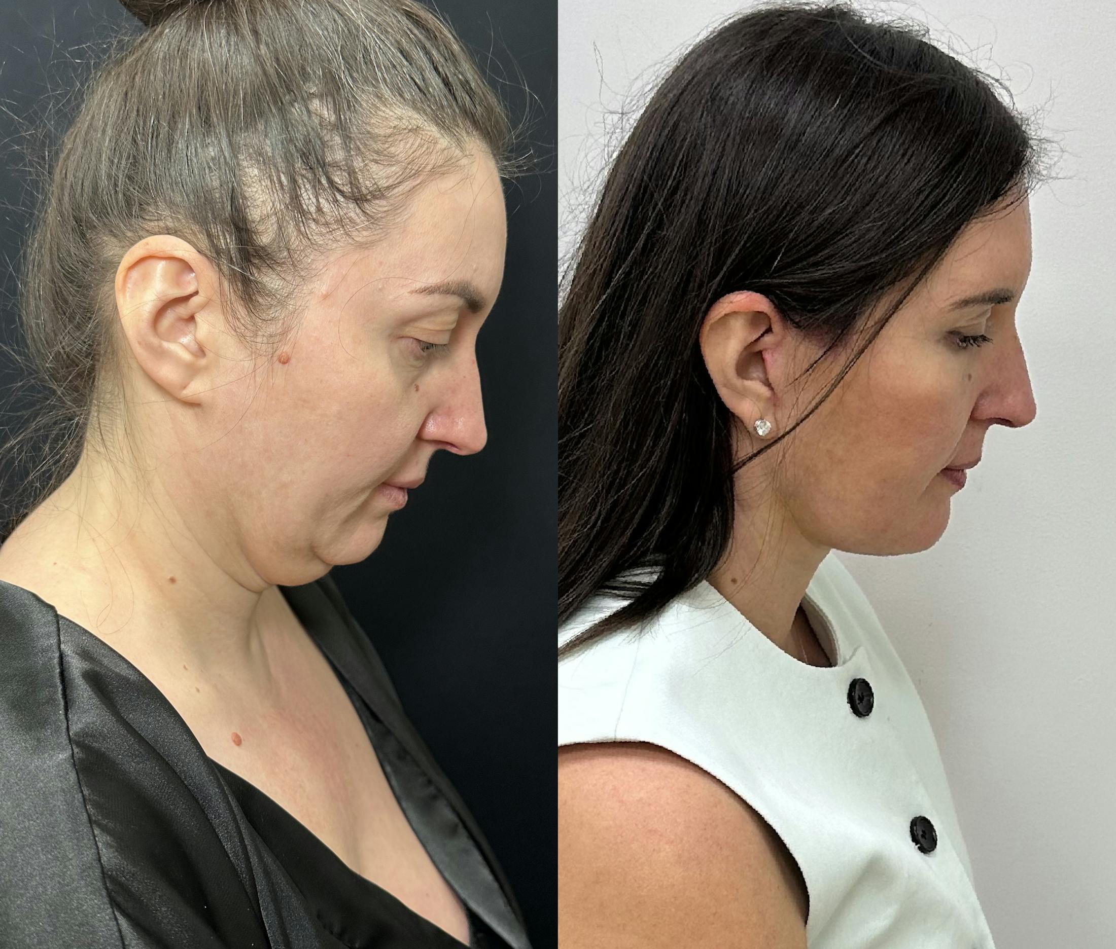Deep Plane Facelift Before & After Gallery - Patient 332332 - Image 3