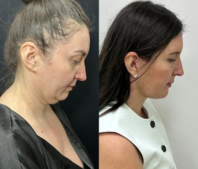 Deep Plane Facelift Before & After Gallery - Patient 332332 - Image 3