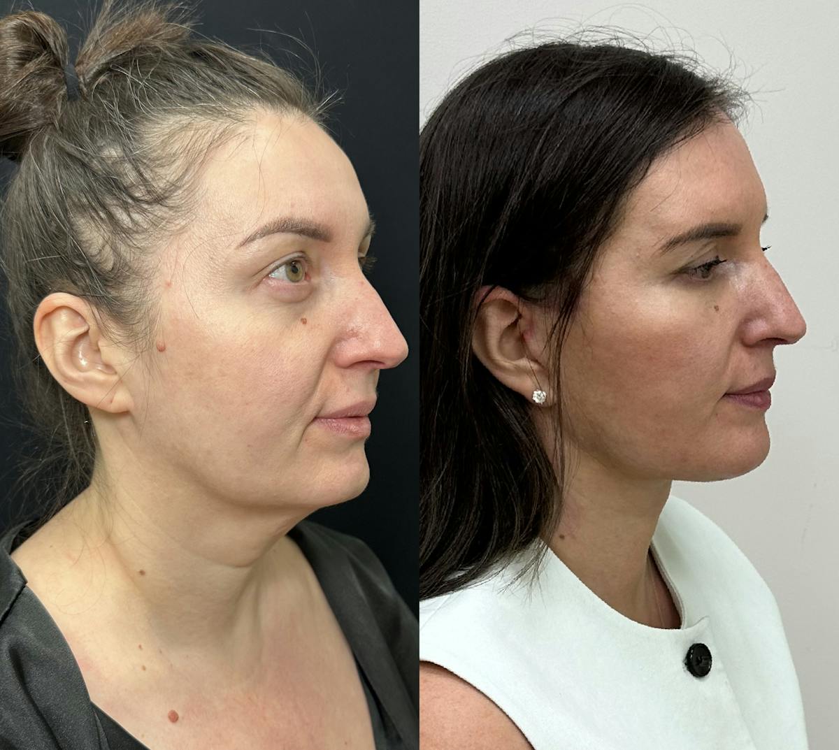 Deep Plane Facelift Before & After Gallery - Patient 332332 - Image 1