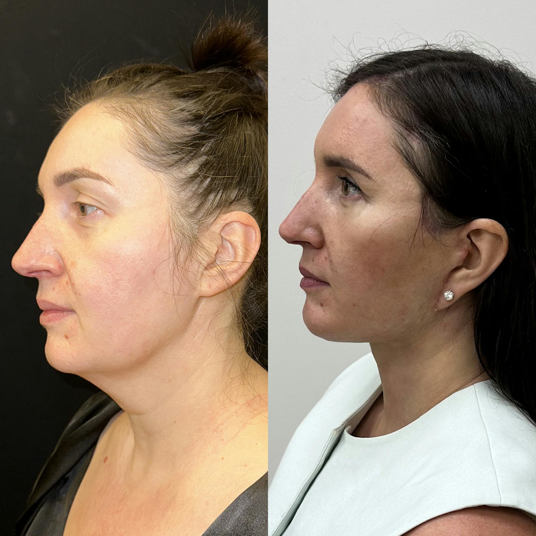 Deep Plane Facelift Before & After Gallery - Patient 332332 - Image 4