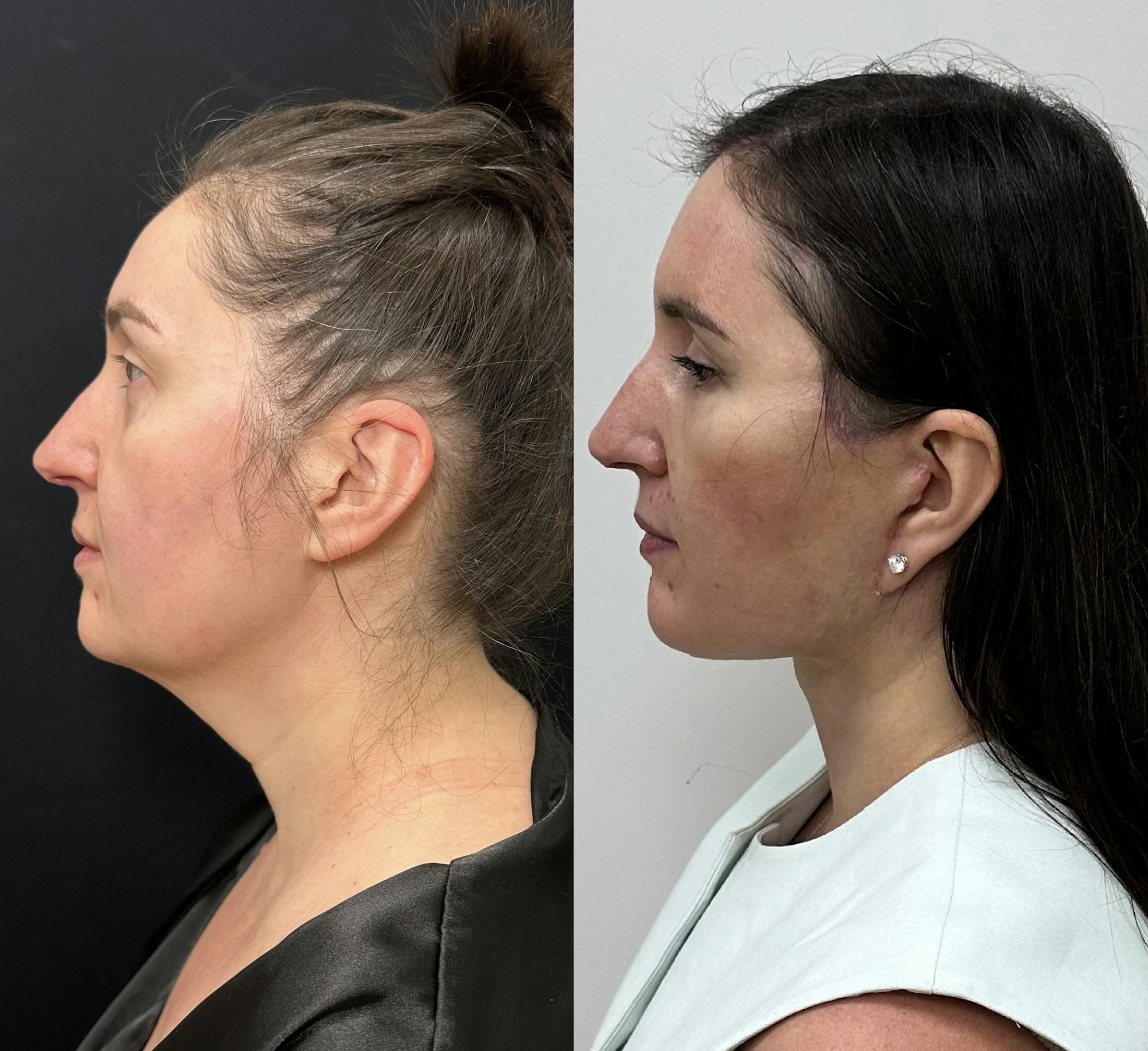 Deep Plane Facelift Before & After Gallery - Patient 332332 - Image 6