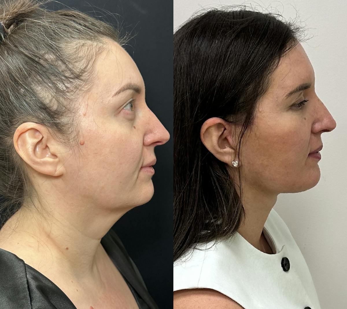 Deep Plane Facelift Before & After Gallery - Patient 332332 - Image 2