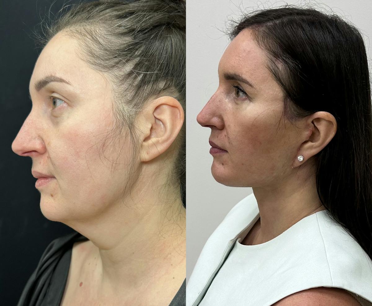 Deep Plane Facelift Before & After Gallery - Patient 332332 - Image 5