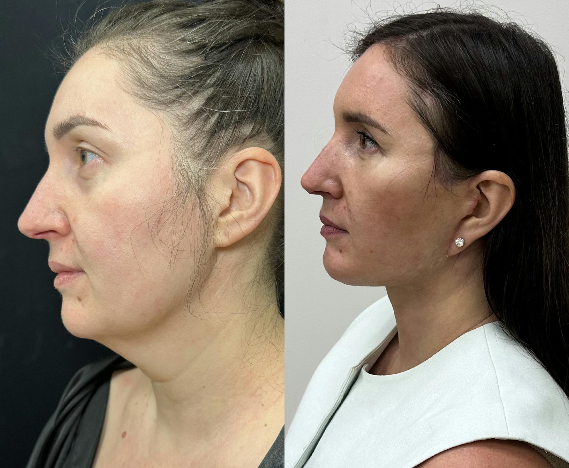 Deep Plane Facelift Before & After Gallery - Patient 332332 - Image 5