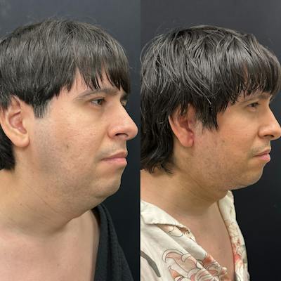 Deep Plane Facelift Before & After Gallery - Patient 405582 - Image 1