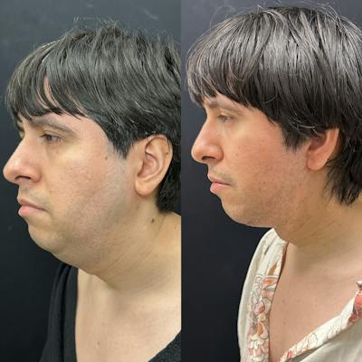 Deep Plane Facelift Before & After Gallery - Patient 405582 - Image 3