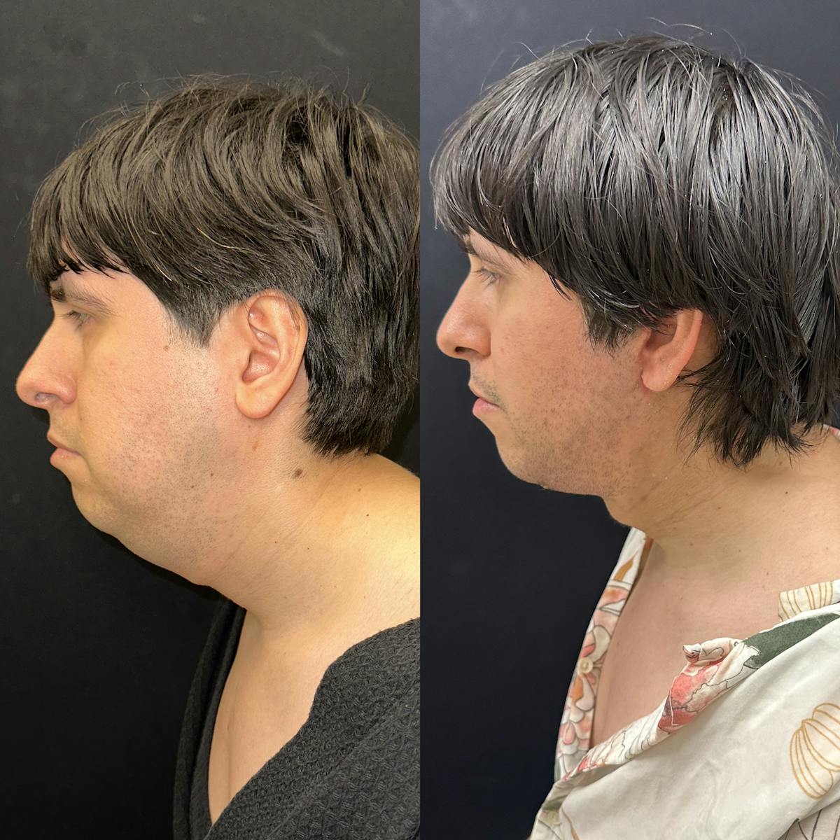 Deep Plane Facelift Before & After Gallery - Patient 405582 - Image 4