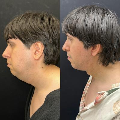 Deep Plane Facelift Before & After Gallery - Patient 405582 - Image 4