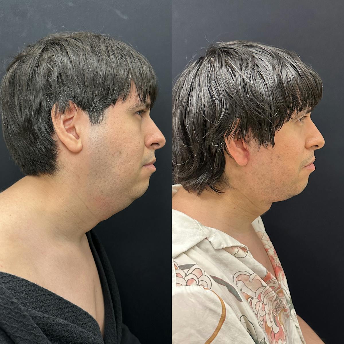 Deep Plane Facelift Before & After Gallery - Patient 405582 - Image 2