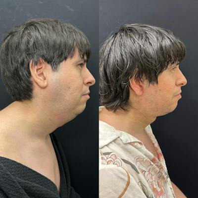 Deep Plane Facelift Before & After Gallery - Patient 405582 - Image 2