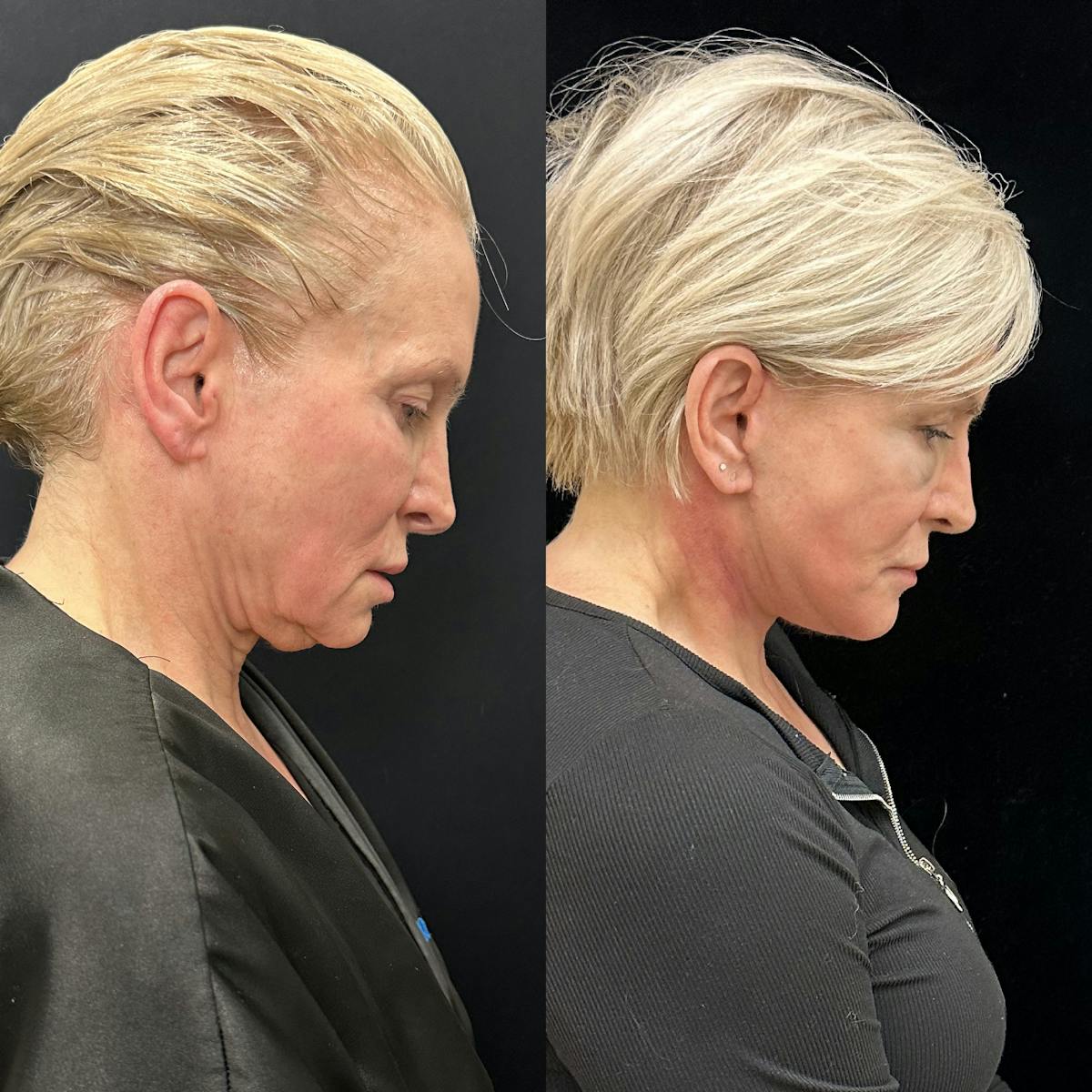 Deep Plane Facelift Before & After Gallery - Patient 664047 - Image 2