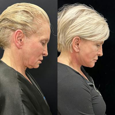 Deep Plane Facelift Before & After Gallery - Patient 664047 - Image 2
