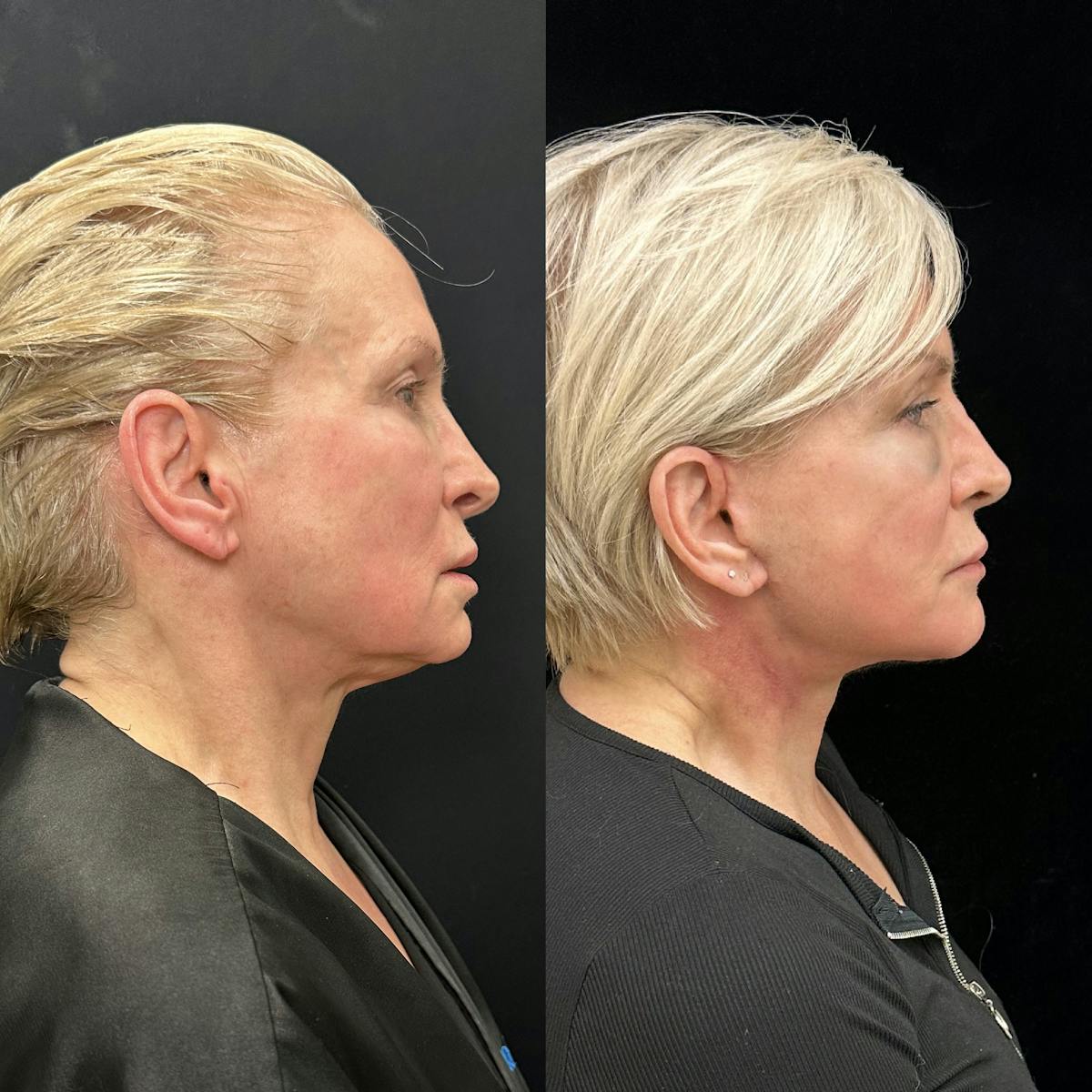 Deep Plane Facelift Before & After Gallery - Patient 664047 - Image 1