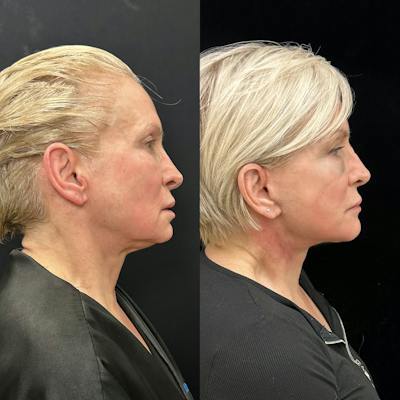 Deep Plane Facelift Before & After Gallery - Patient 664047 - Image 1