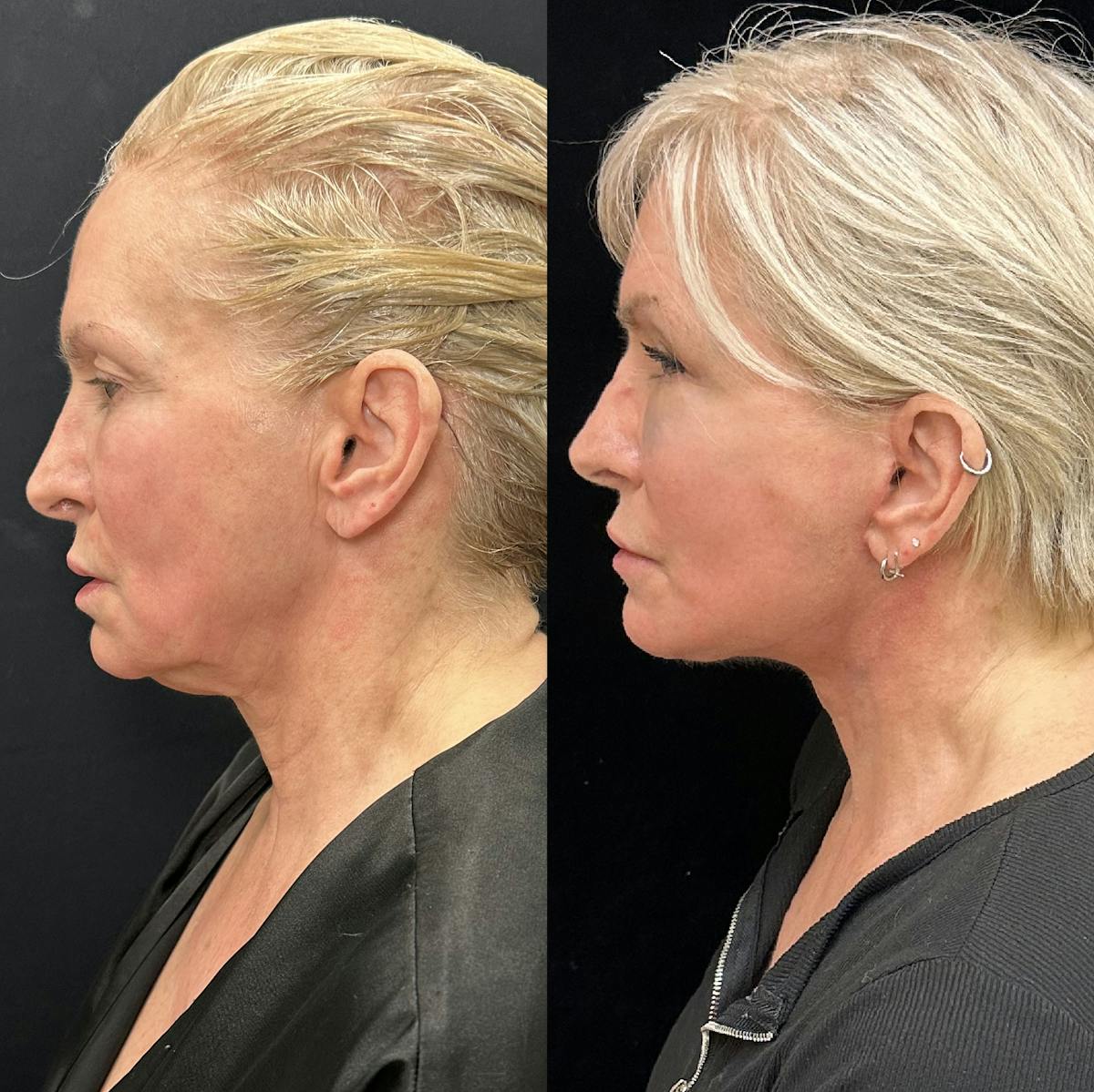 Deep Plane Facelift Before & After Gallery - Patient 664047 - Image 3